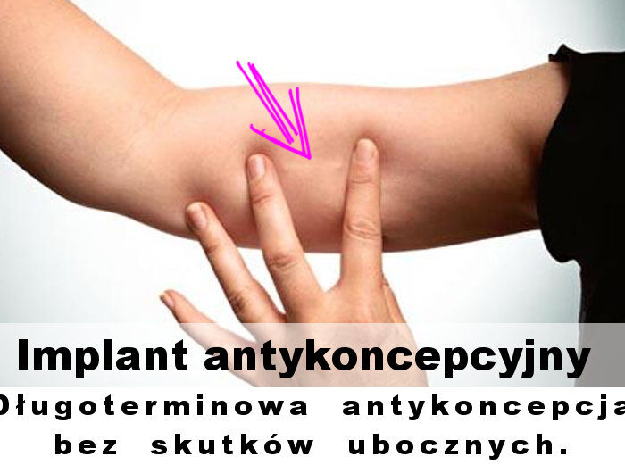 Implant antykoncepcyjny